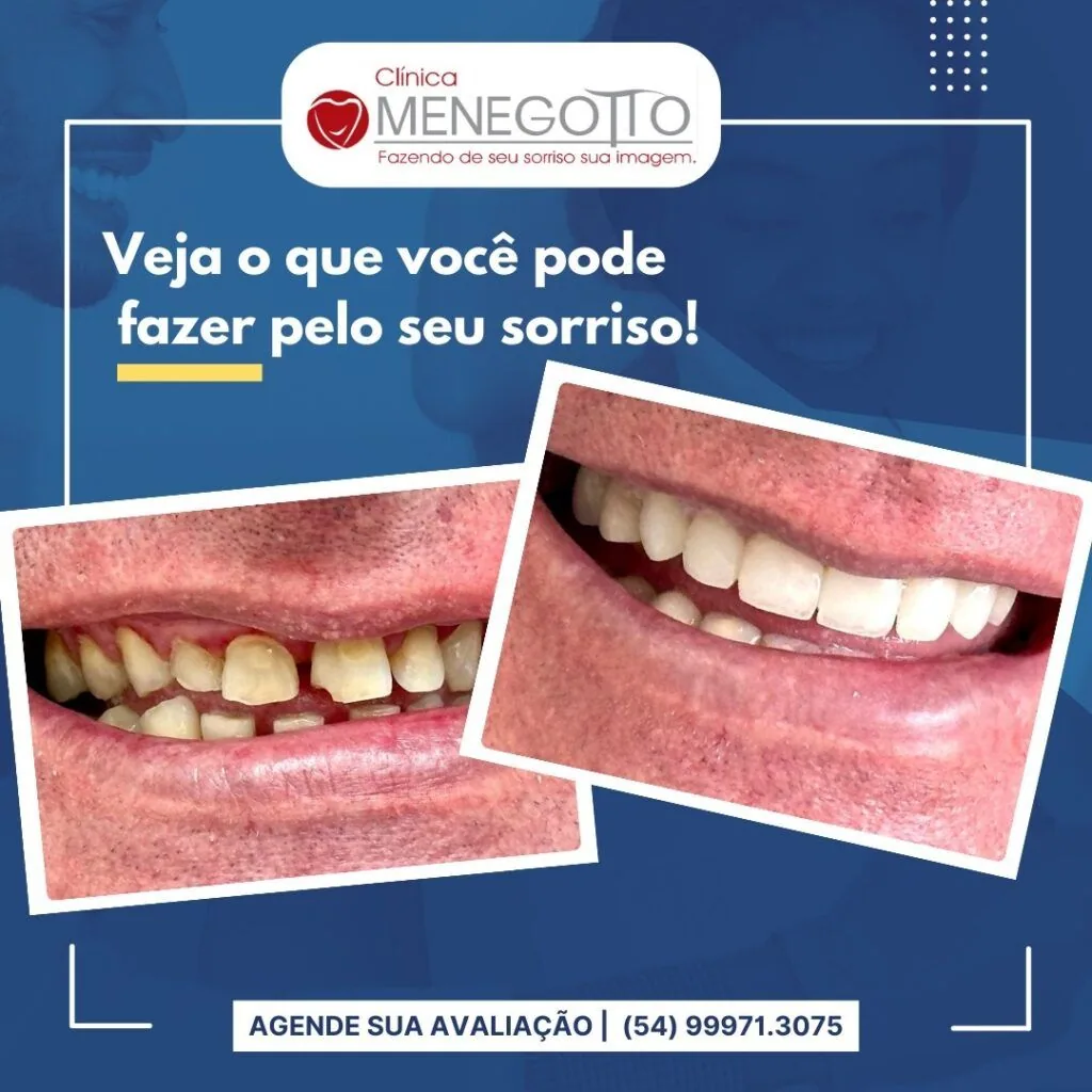 Blog 36 1024x1024 na Clínica Odontológica Menegotto