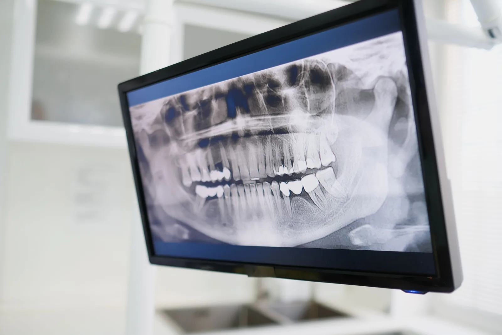 Radiografia panorâmica exibida em um monitor