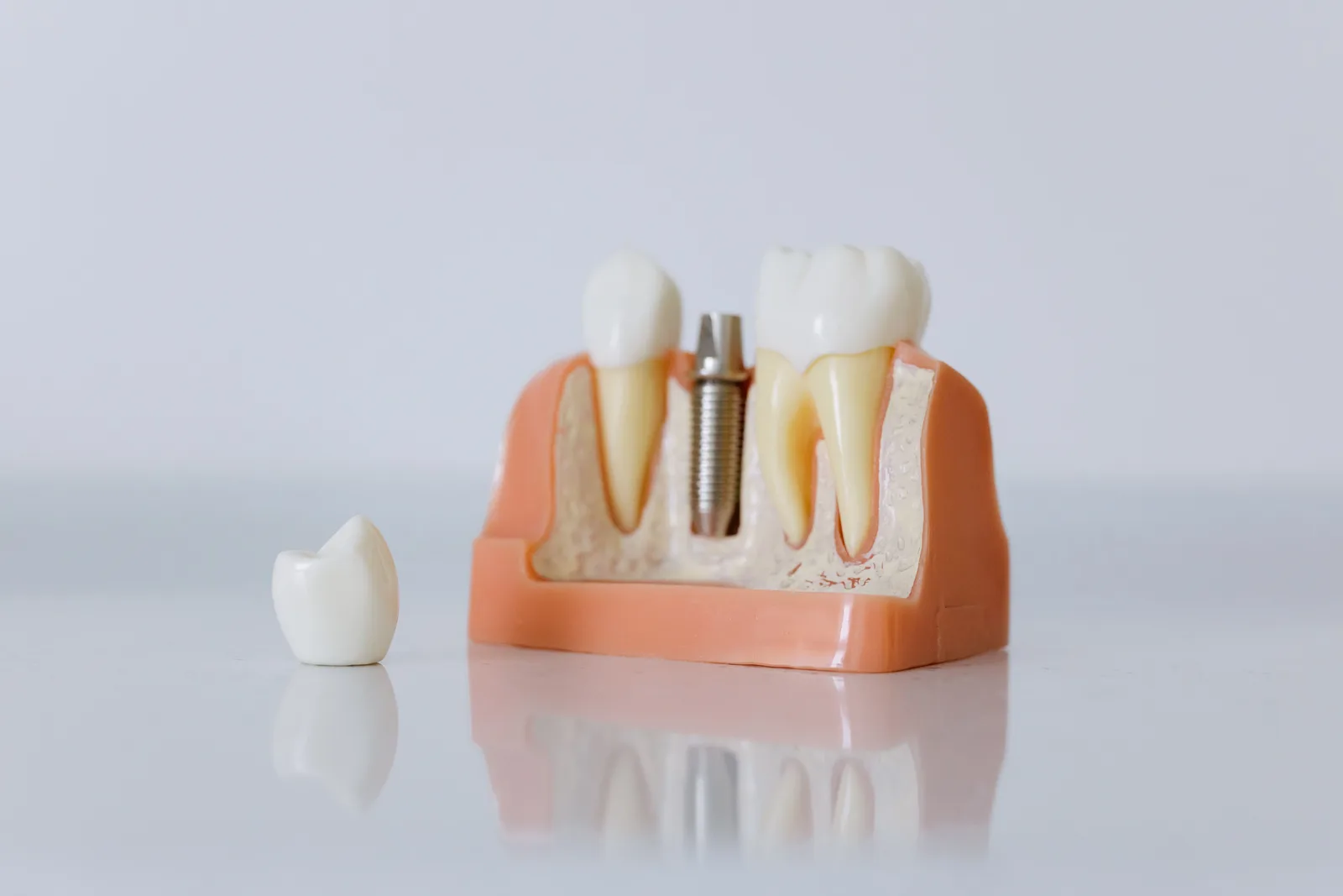 Modelo de implante dentário visto de perto