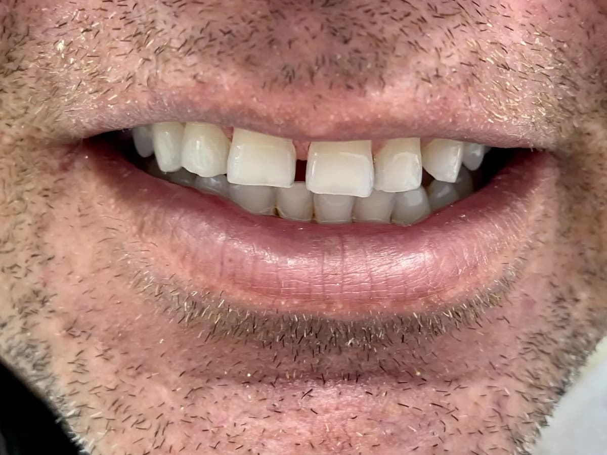 Facetas de porcelana: antes do tratamento