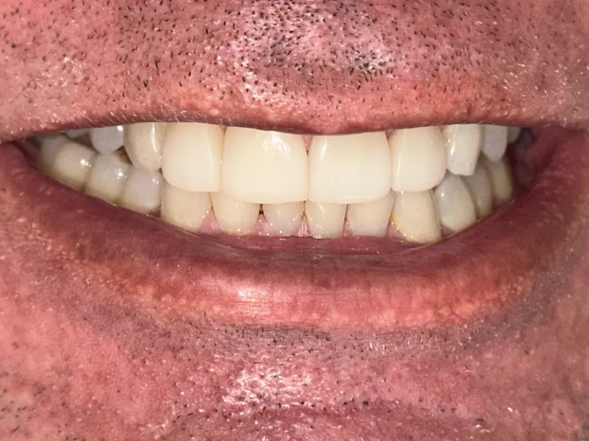 Facetas de porcelana: depois do tratamento