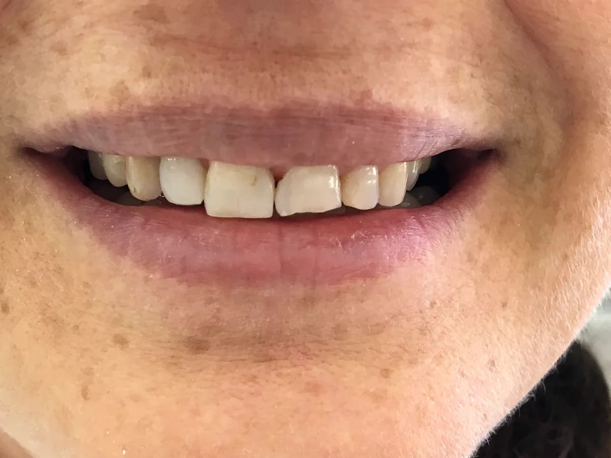 Facetas de porcelana: antes do tratamento