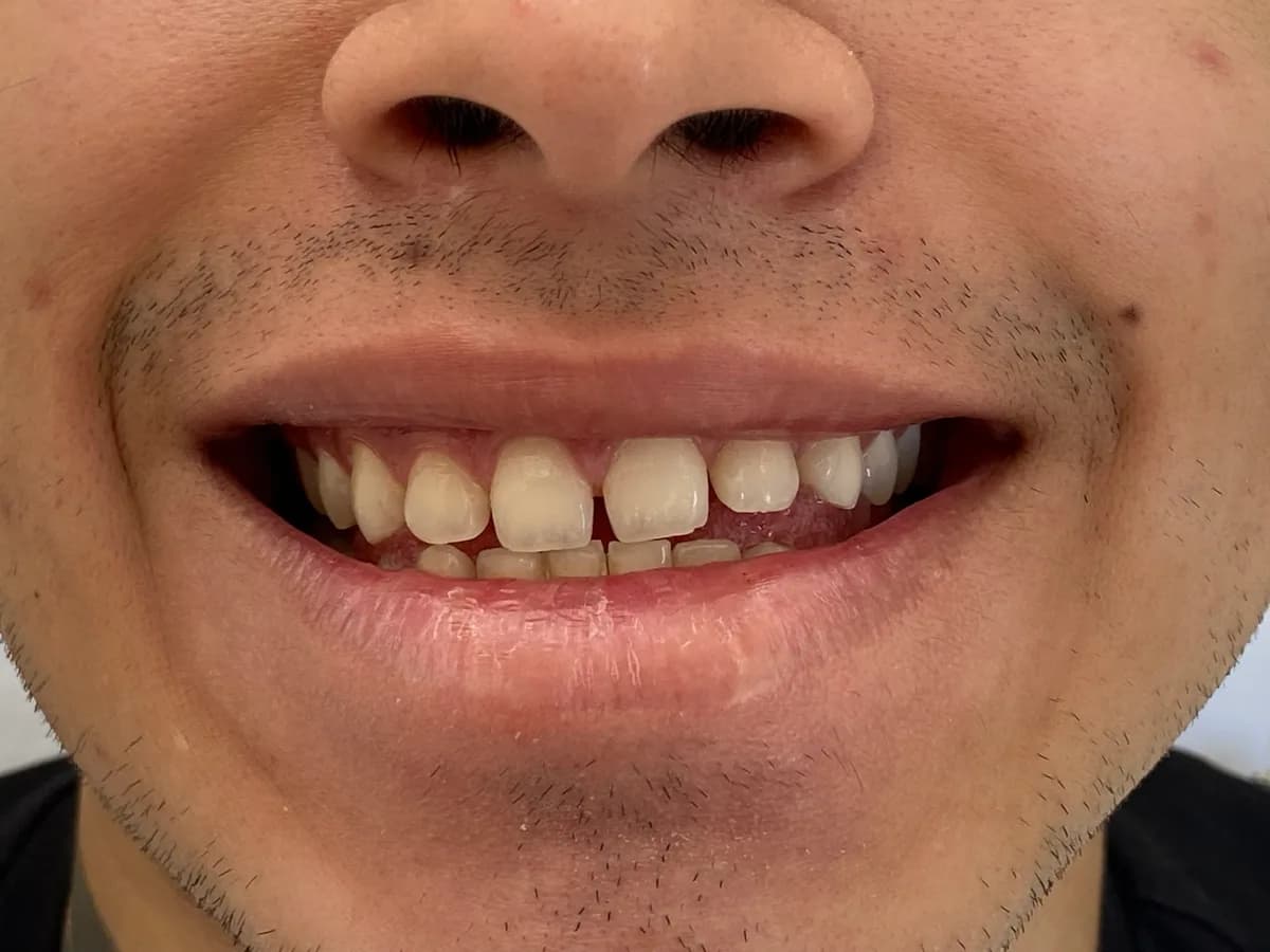 Facetas de resina: antes do tratamento
