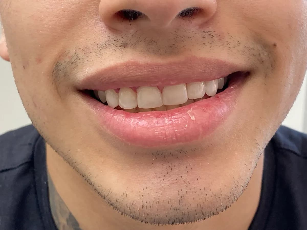 Facetas de resina: depois do tratamento