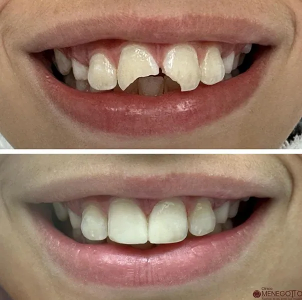 Dentes fraturados 01 na Clínica Odontológica Menegotto