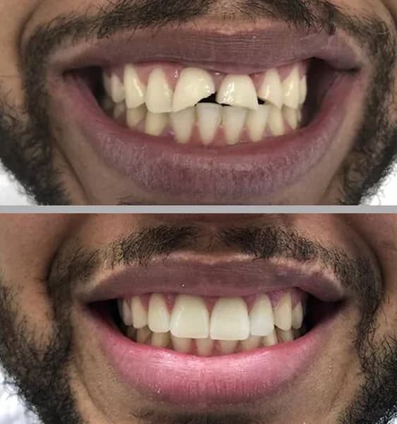 Dentes fraturados 02 na Clínica Odontológica Menegotto