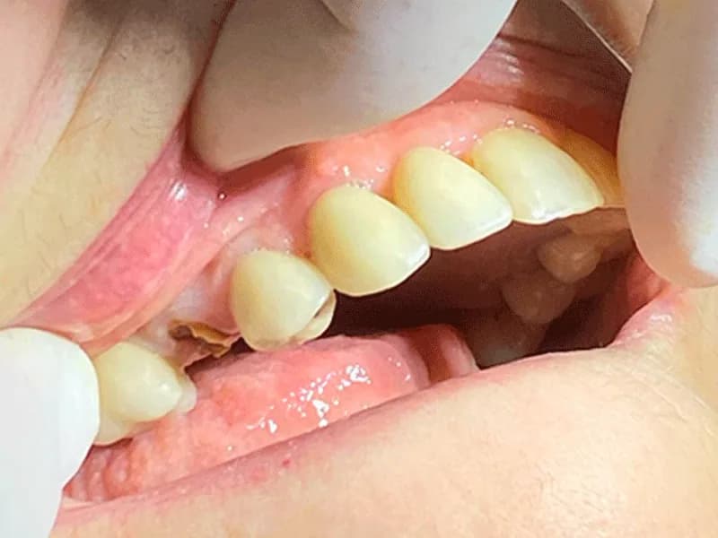 Implantes Dentários: situação antes do tratamento