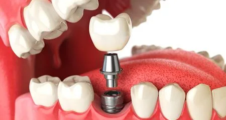 Tratamento odontológico na Clínica Odontológica Menegotto