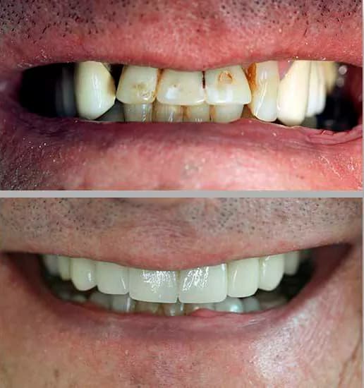 Implantes Dentários: comparação de antes e depois do tratamento