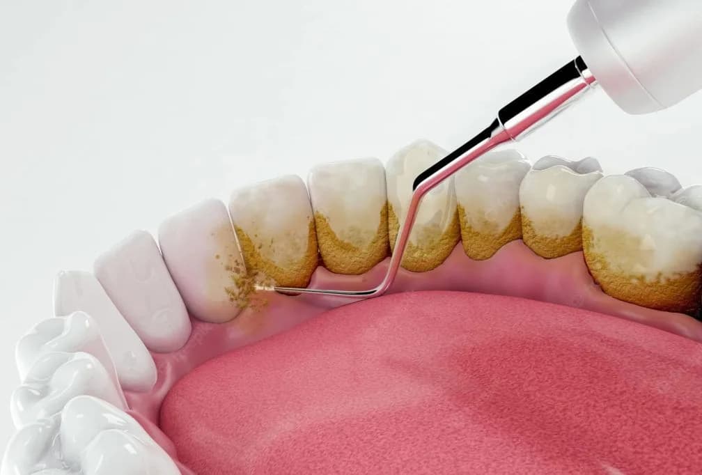 Od cl mod 1 0 na Clínica Odontológica Menegotto