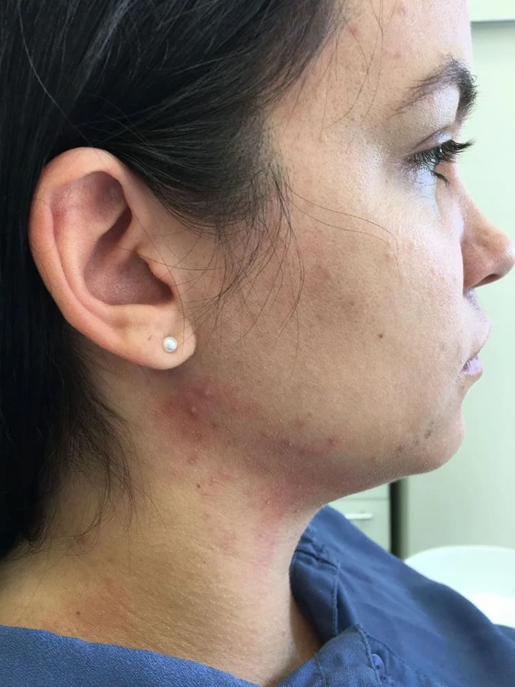 Remocao papada 02 na Clínica Odontológica Menegotto