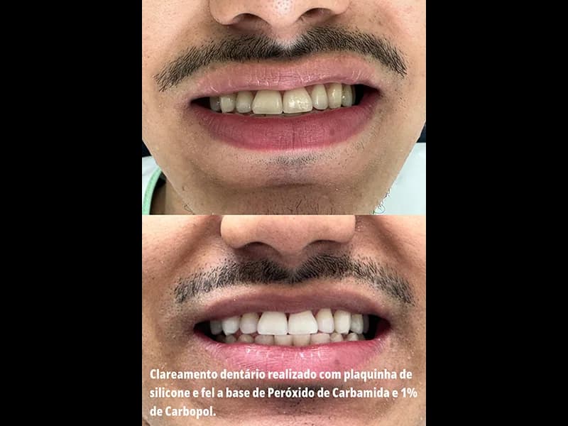 Clareamento caseiro 2 na Clínica Odontológica Menegotto