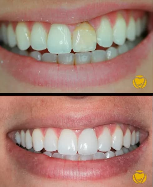 Clareamento dentario 01 na Clínica Odontológica Menegotto