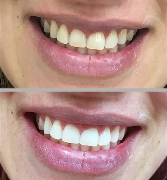 Clareamento laser 3 na Clínica Odontológica Menegotto