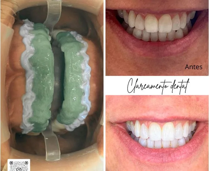 Clareamento laser1 na Clínica Odontológica Menegotto