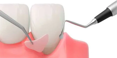 Clinica manegotto enxerto gengival na Clínica Odontológica Menegotto