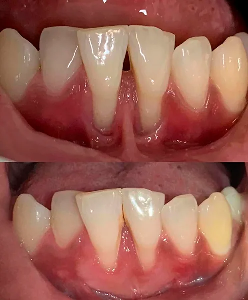 Enxerto gengival 02 na Clínica Odontológica Menegotto