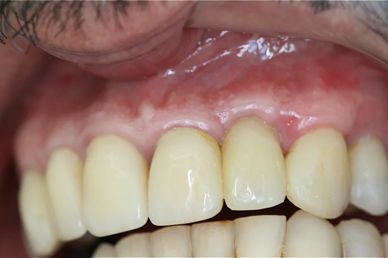 Clinicamenegotto enxertoosso3 na Clínica Odontológica Menegotto