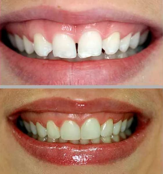 Entredentes clinicamenegotto 01 na Clínica Odontológica Menegotto