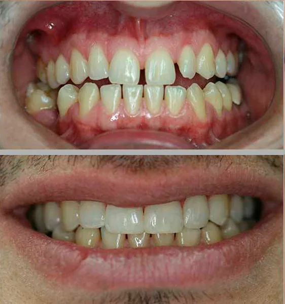 Entredentes clinicamenegotto 02 na Clínica Odontológica Menegotto