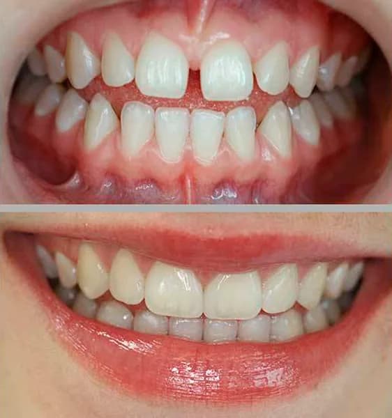 Entredentes clinicamenegotto 03 na Clínica Odontológica Menegotto