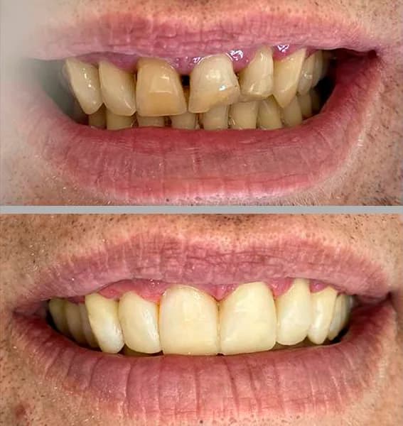 Entredentes clinicamenegotto 04 na Clínica Odontológica Menegotto