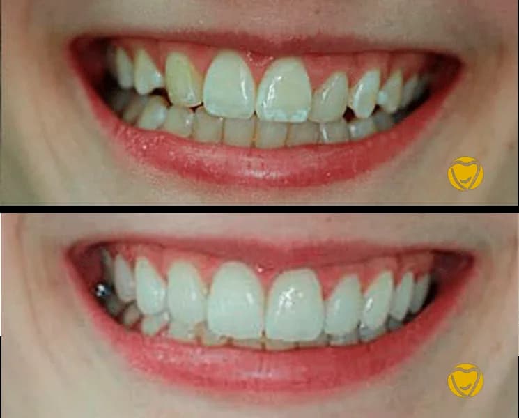 Faceta porcela na Clínica Odontológica Menegotto