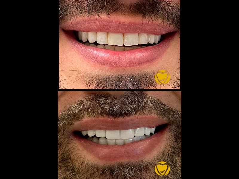 Facetas porcelana 02 na Clínica Odontológica Menegotto
