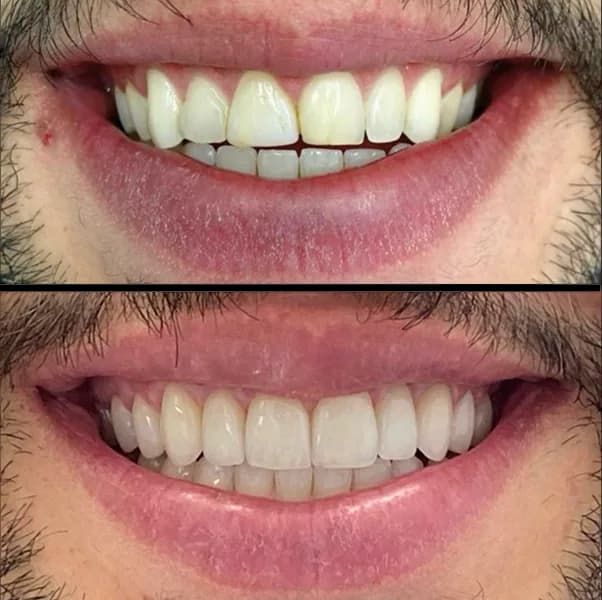 Facetas porcelana 1 na Clínica Odontológica Menegotto