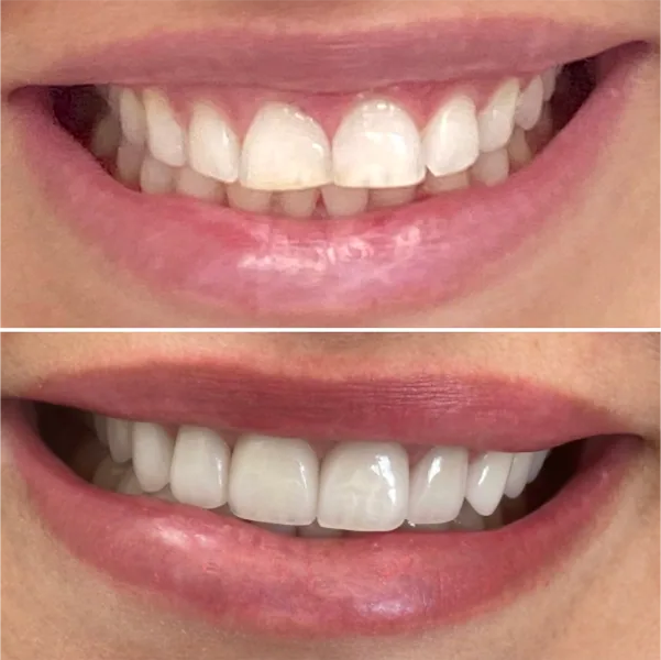 Facetas porcelana 2 na Clínica Odontológica Menegotto