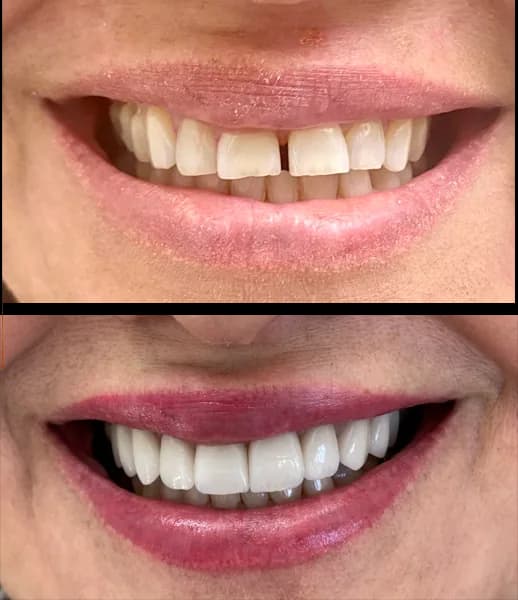 Facetas porcelana 3 na Clínica Odontológica Menegotto