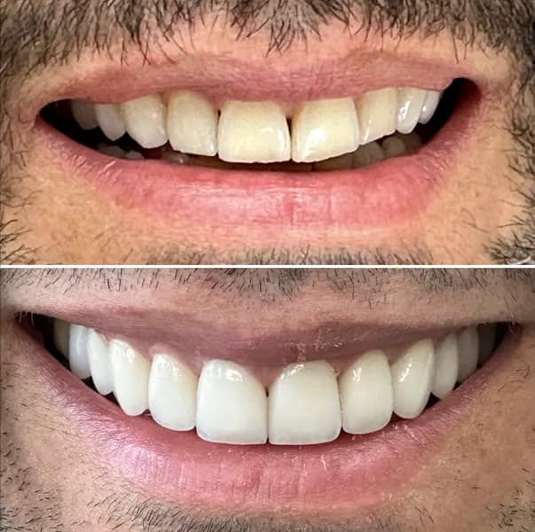 Facetas porcelana 4 na Clínica Odontológica Menegotto
