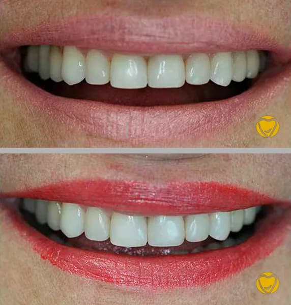 Faceta resina clinica menegotti 02 na Clínica Odontológica Menegotto