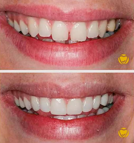 Faceta resina clinica menegotti 03 na Clínica Odontológica Menegotto