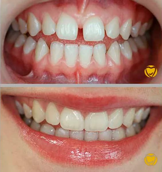 Faceta resina clinica menegotti 04 na Clínica Odontológica Menegotto