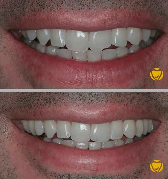 Faceta resina clinica menegotti 06 na Clínica Odontológica Menegotto