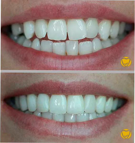 Faceta resina clinica menegotti 09 na Clínica Odontológica Menegotto