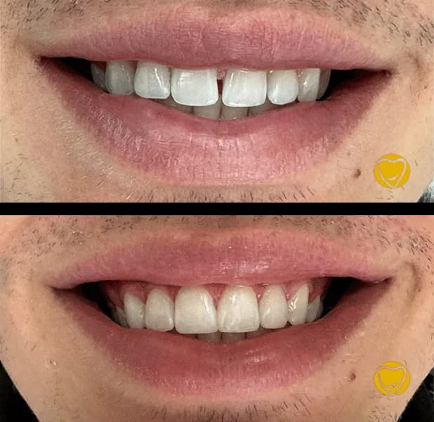 Faceta resina clinica menegotti 11 na Clínica Odontológica Menegotto