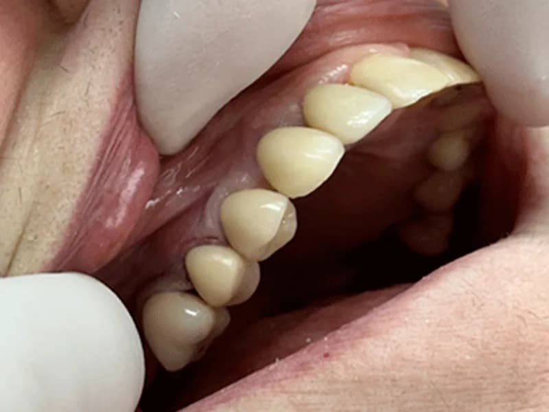 Implantes Dentários: resultado depois do tratamento