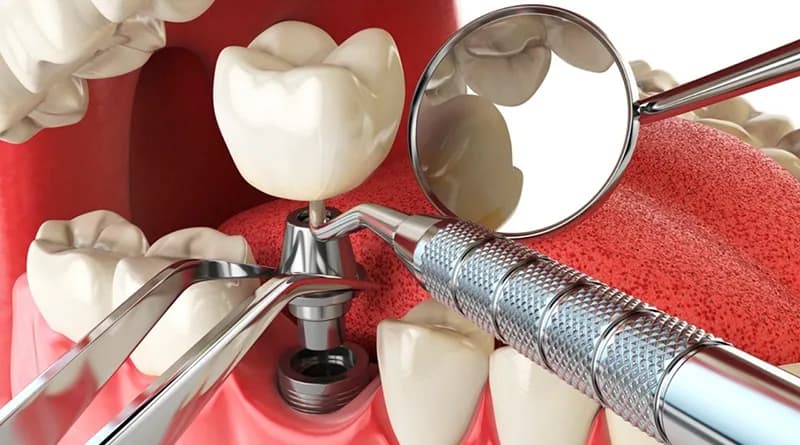 Implante clinicamanegotto na Clínica Odontológica Menegotto