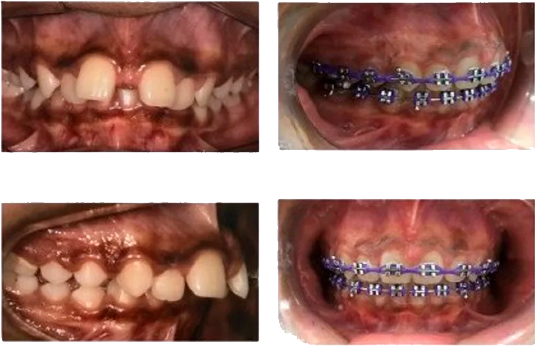 Ortodontia clinicamenegotto 02 na Clínica Odontológica Menegotto