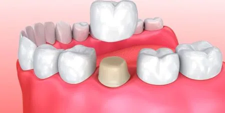Esquema de coroa de porcelana sobre dente preparado