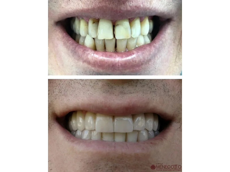 Protese sobre dente porcelana 02 na Clínica Odontológica Menegotto