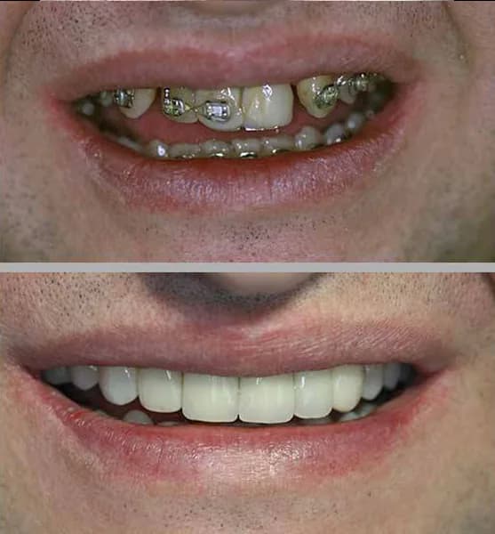 Protese sobre dente porcelana 03 na Clínica Odontológica Menegotto