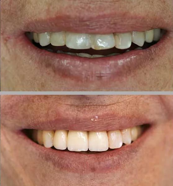 Protese sobre dente porcelana 04 na Clínica Odontológica Menegotto