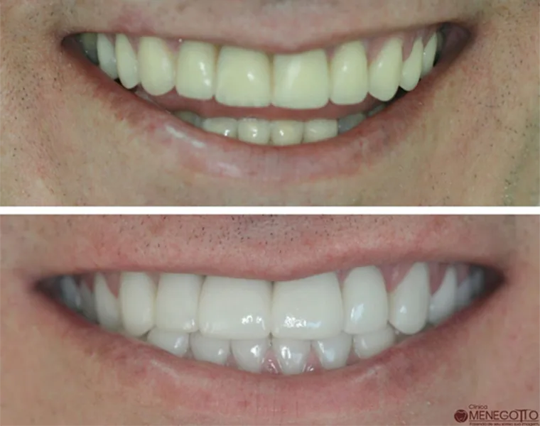 Protese sobre dente porcelana 01 na Clínica Odontológica Menegotto
