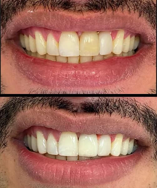 Protese sobre implante 3 na Clínica Odontológica Menegotto