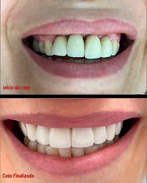 Protese sobre implante 4 na Clínica Odontológica Menegotto