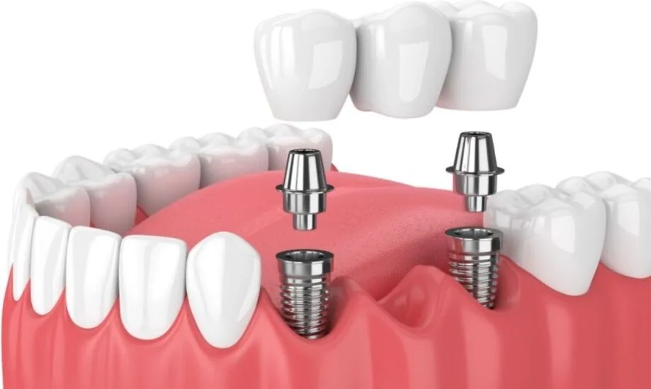 Esquema de prótese de porcelana instalada sobre implantes