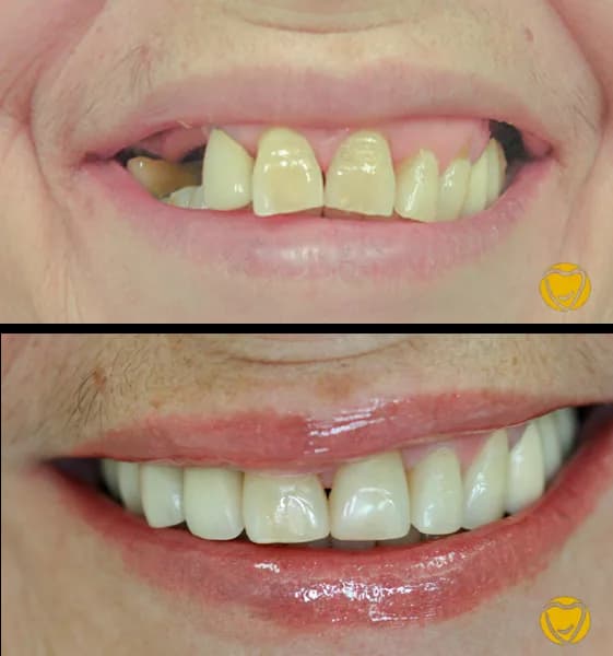 Protese sobre implante 01 clinicamenegotto na Clínica Odontológica Menegotto